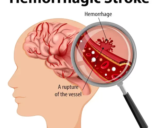 Brain Hemorrhage (Bleeding) : Causes, Symptoms, Types and Treatments