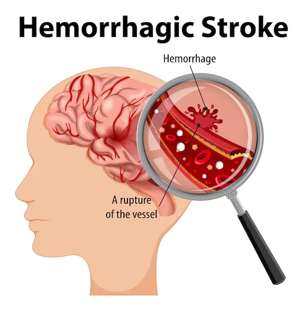 Brain Hemorrhage (Bleeding) : Causes, Symptoms, Types and Treatments